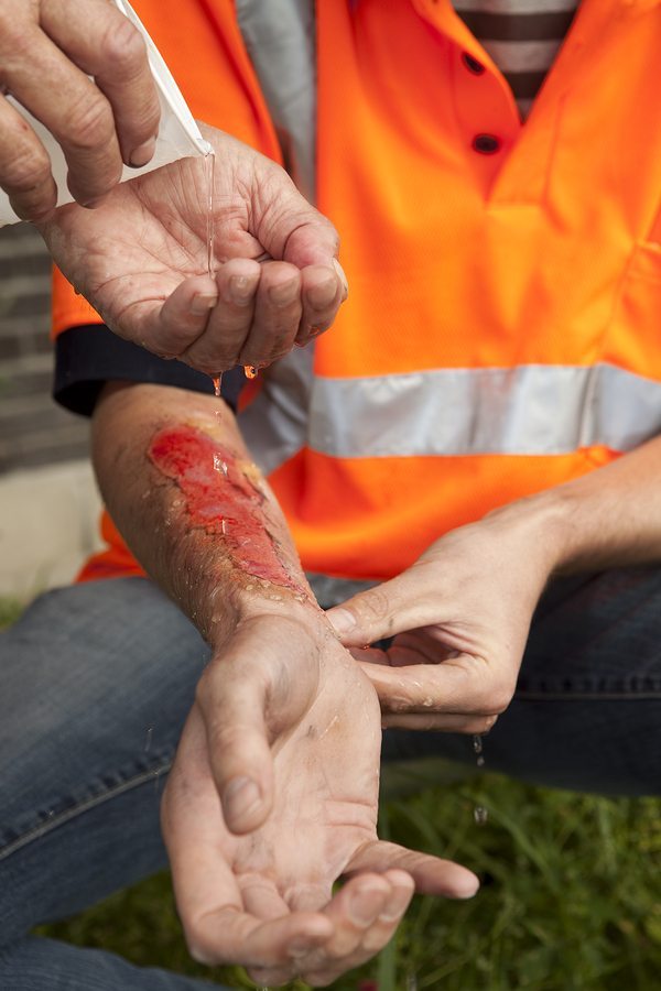 Red burn on man wearing an orange safety vest receiving water for the wound - burn victims concept