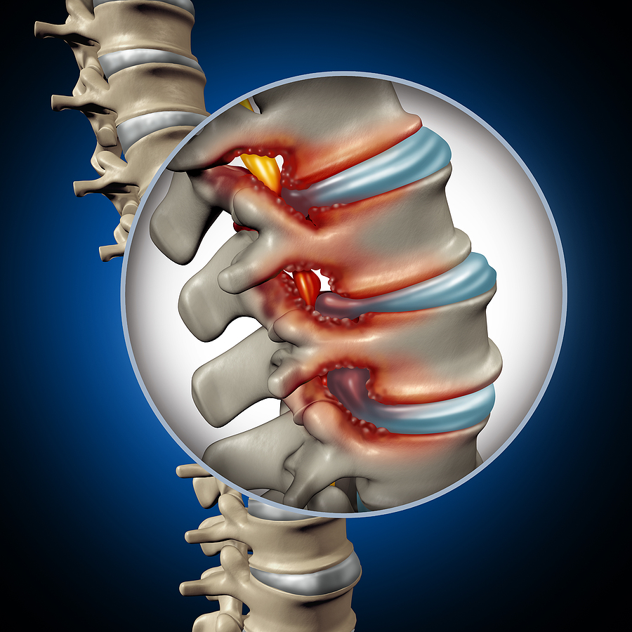 spinal stenosis diagram - 3d rendered image of spinal stenoisis, pinching of spinal cord by narrowing of the spine
